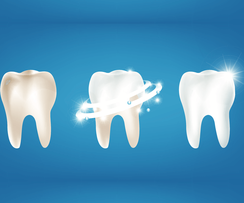 Teeth Whitening in Noida - dental treatment in Noida