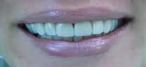 Dental Treatment in noida - After dental treatment