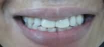 Dental Treatment in noida - After dental treatment