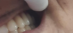Dental Treatment in noida - Before dental treatment