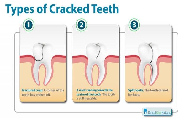 Cracked Tooth