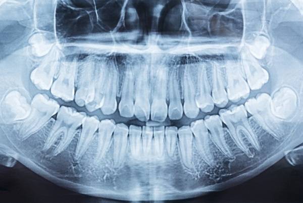 The Risk of Delaying Your Wisdom Teeth Extraction