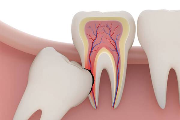 RISK OF DELAYING WISDOM TOOTH EXTRACTION