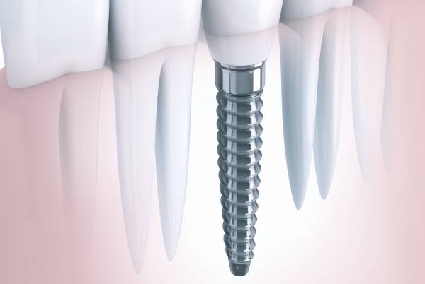 Dental Implants
