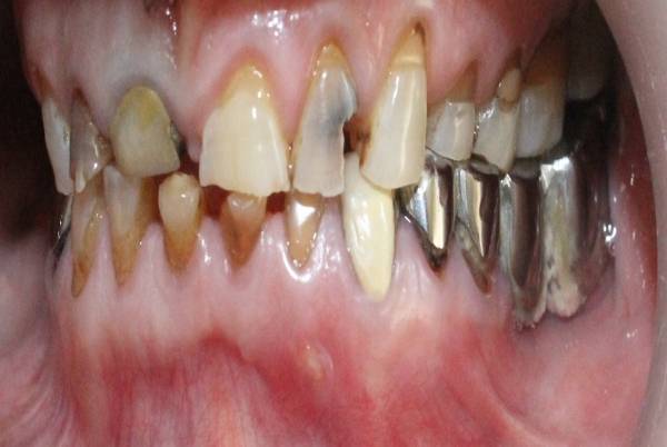 Case of traumatic deep bite.