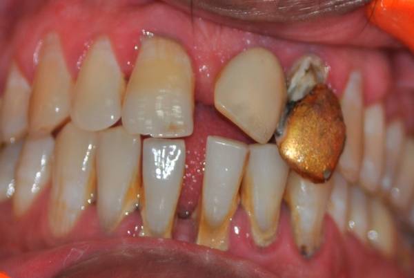 Acrylic Temporary Crown