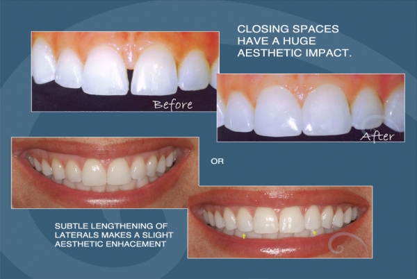 How Dental Bonding Can Alter the Look and Feel of Your Teeth
