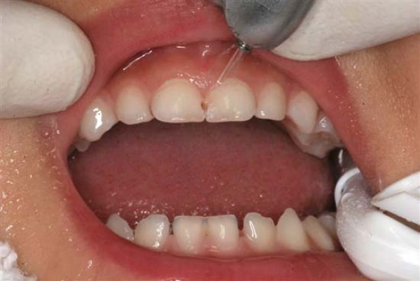 Dental Caries (Tooth Decay) in Children