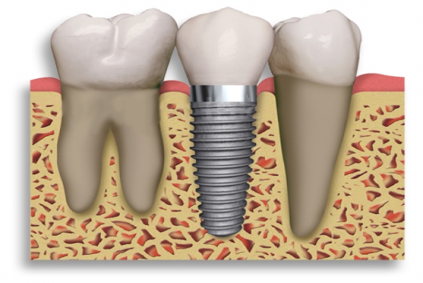 What are Dental Implants?