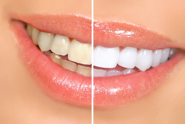 All About Teeth Whitening