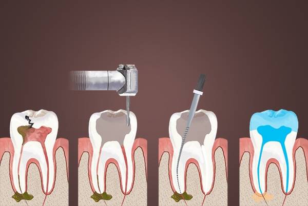 Get Information About Root Canal Procedure for Infected Toot...
