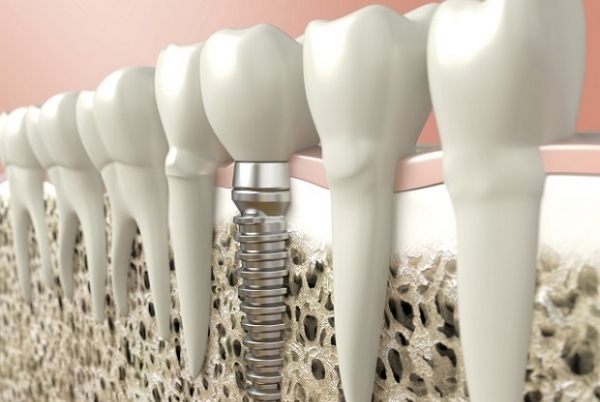5 Dental Implant Facts You May Not Know