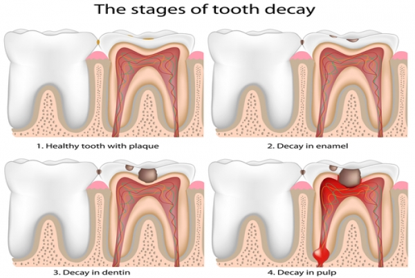 What Is Toothache, Its Causes, and Symptoms and How to Preve...
