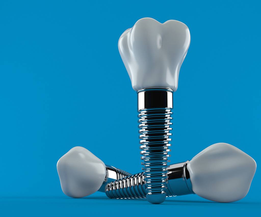 Dental Implant in Noida - dental treatment in Noida