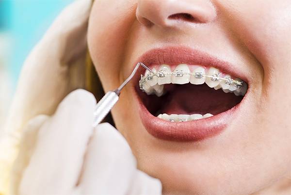 EVERYTHING YOU SHOULD KNOW ABOUT LASER TEETH WHITENING...
