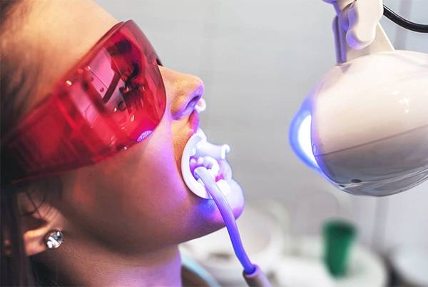EVERYTHING YOU SHOULD KNOW ABOUT LASER TEETH WHITENING