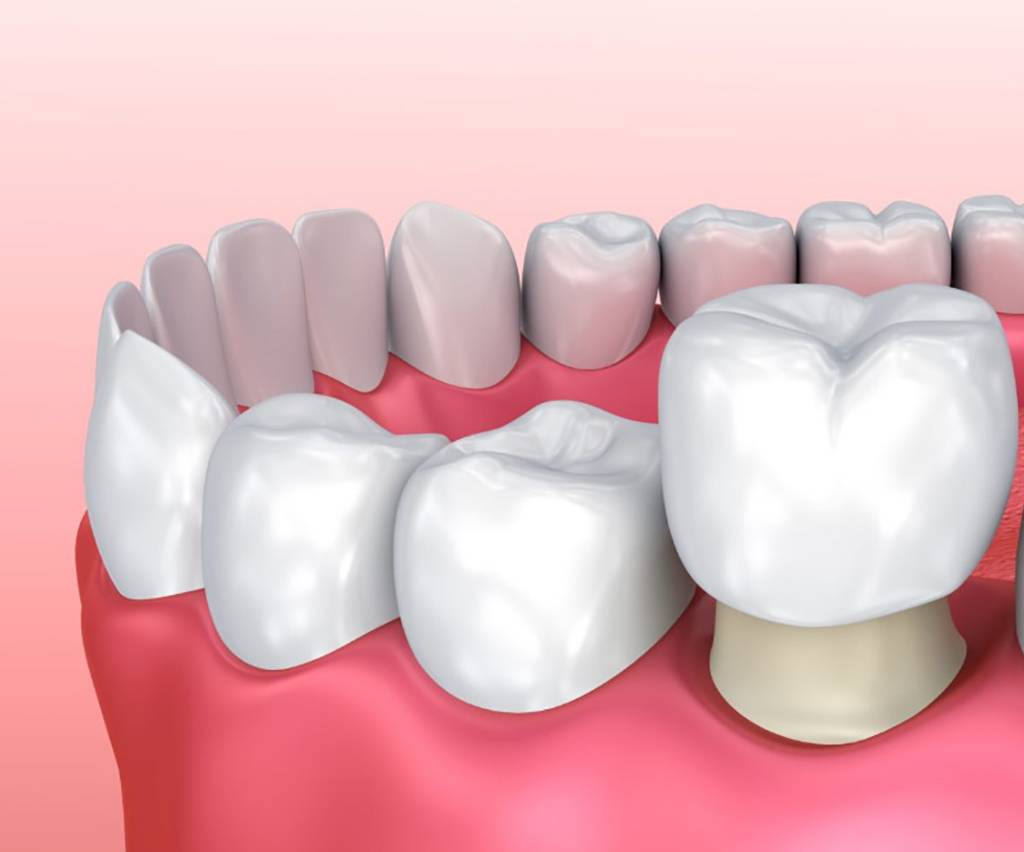 Best Dental Crowns and Bridges in Noida - dental treatment in Noida