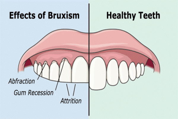 Dental health and teeth grinding (bruxism)