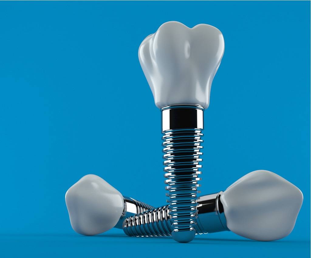 Dental Implant in Noida - dental treatment in Noida