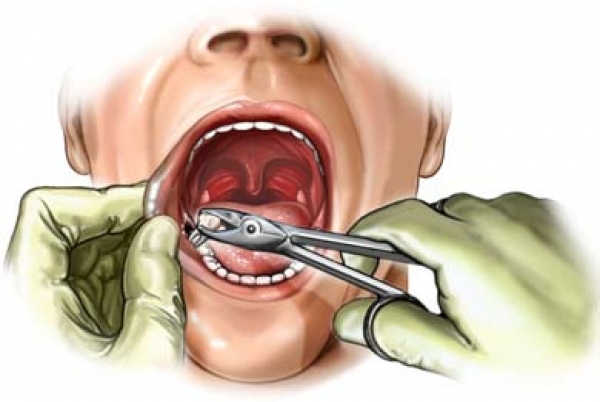 Common Reasons for a Tooth Extraction
