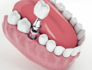 How much does a dental implant cost in India?