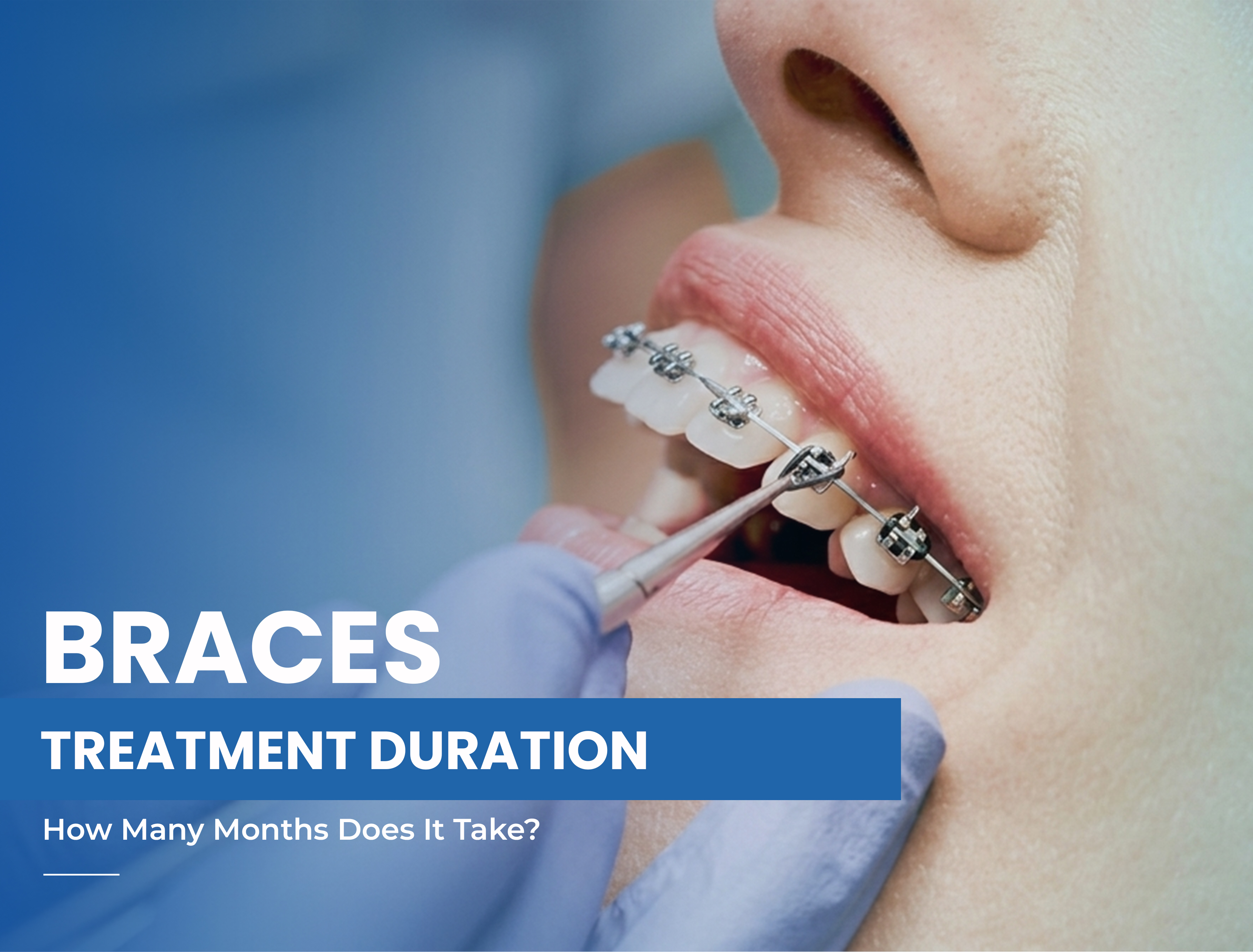 Braces Treatment Duration: How Many Months Does It Take?