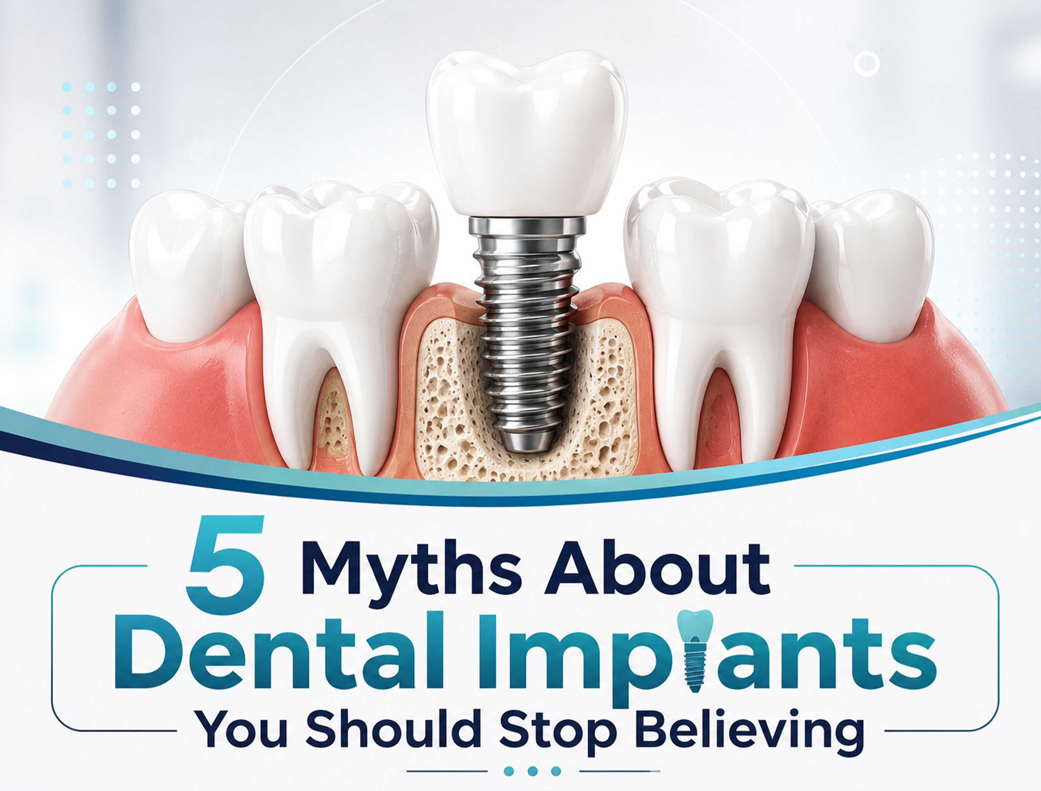 5 Myths About Dental Implants You Should Stop Believing