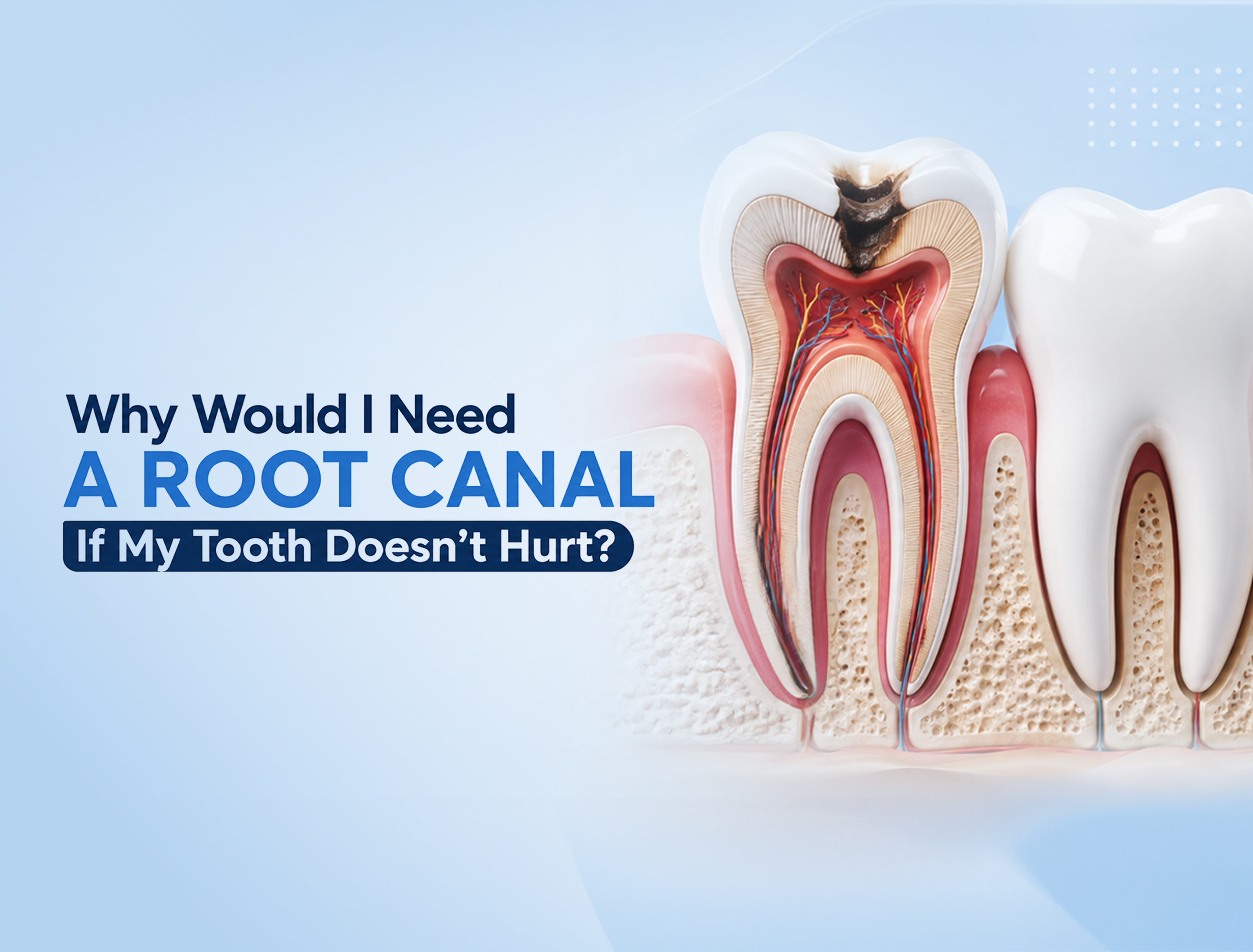 Why Would I Need a Root Canal if My Tooth Doesn't Hurt?
