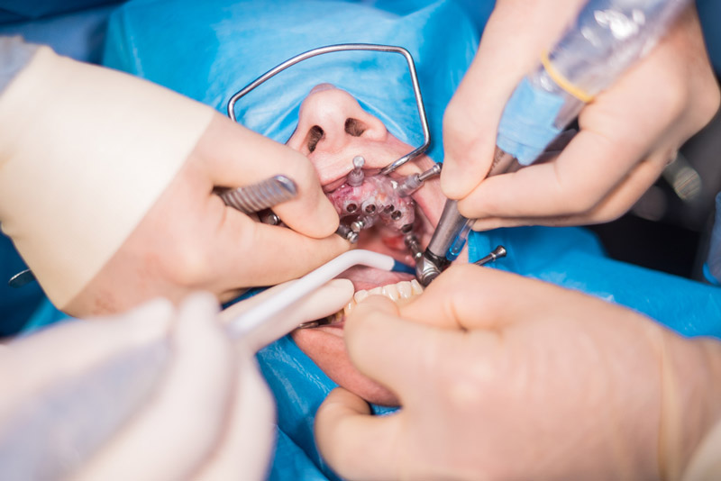 Dental Procedure in Noida - dental treatment in Noida