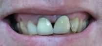 Dental Treatment in noida - Before dental treatment